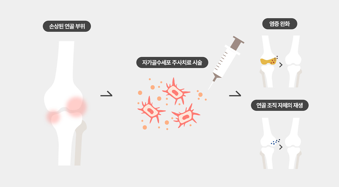 무릎줄기세포치료 과정