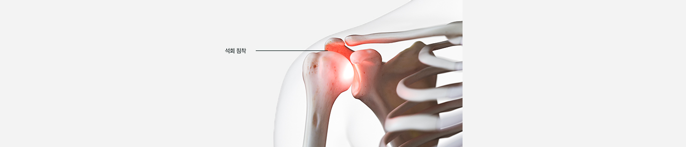 리파정형외과 석회성건염 치료병원